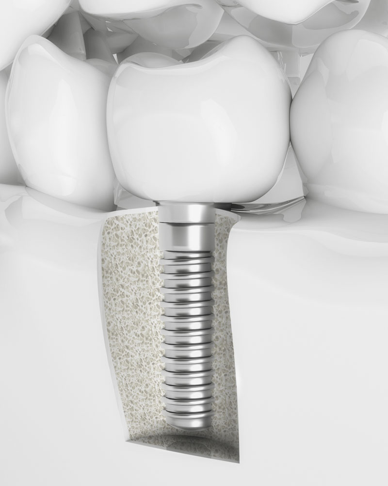 bone grafting for dental implants The Oral Surgery Group
