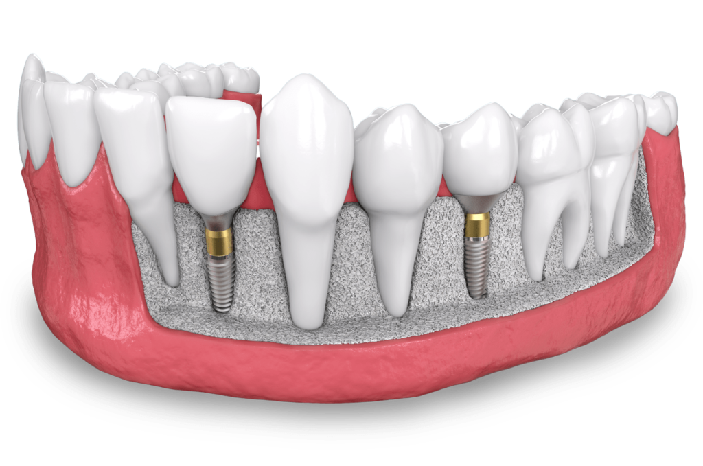 dental implant model The Oral Surgery Group