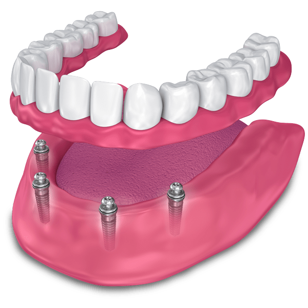 implant supported dentures model The Oral Surgery Group