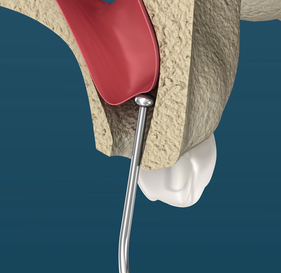 sinus lift model The Oral Surgery Group