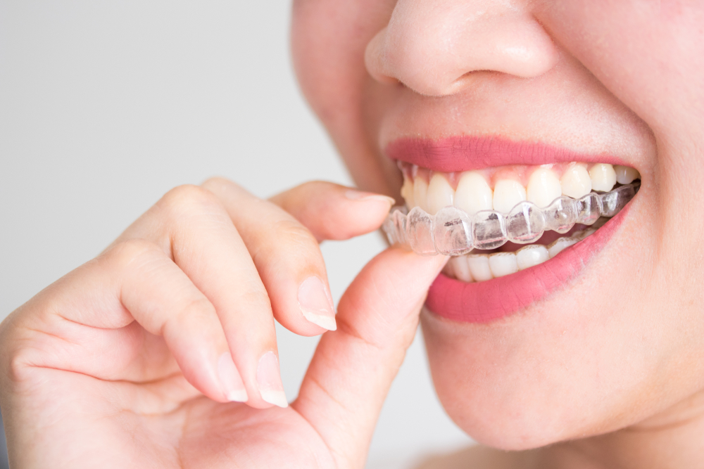 The Aligning of Misaligned Teeth