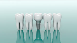 Dental Implants