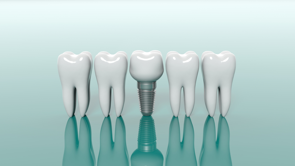 Dental Implants